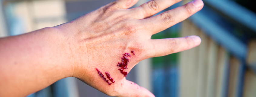Bloody hand caused by dog bite